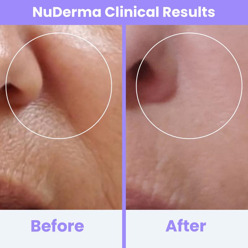 Radiant Skin High-Frequency Therapy™