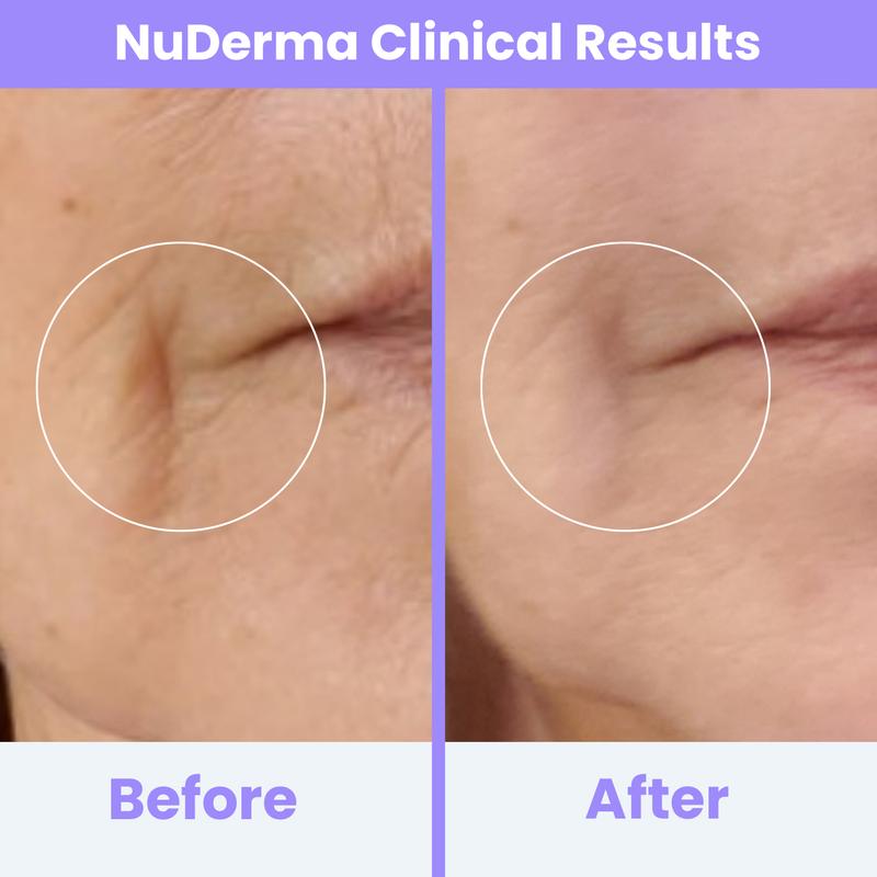 Radiant Skin High-Frequency Therapy™