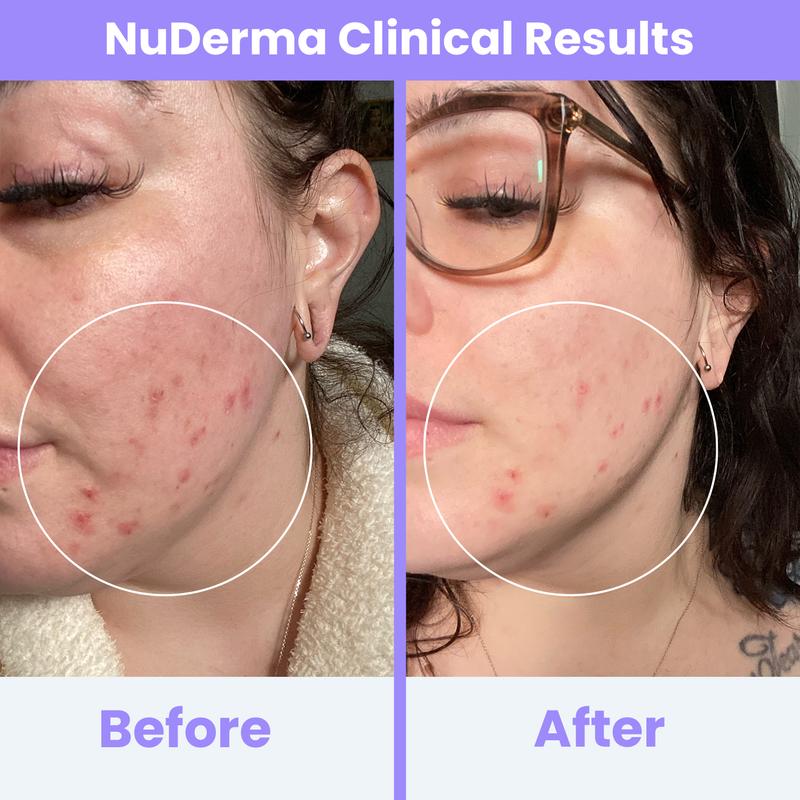 Radiant Skin High-Frequency Therapy™
