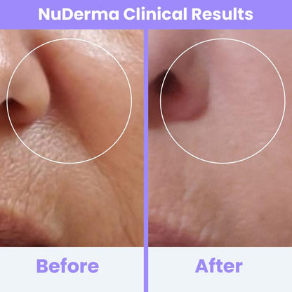 Radiant Skin High-Frequency Therapy™