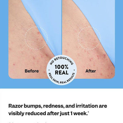 Smoothing Solution Ingrown Hair Treatment
