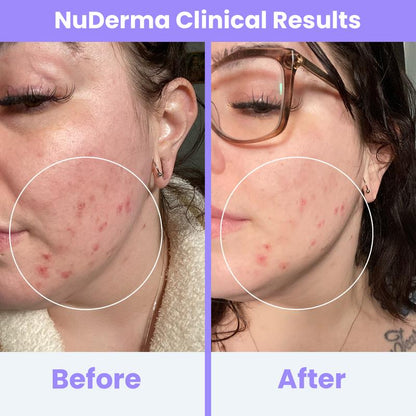 Radiant Skin High-Frequency Therapy™